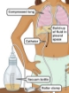 Picture of Chest Drainage Catheter, Tube + Connector